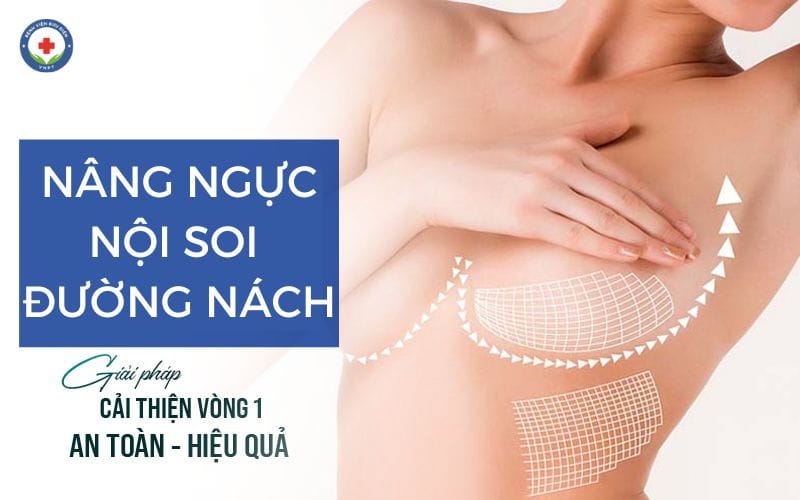 Nâng ngực nội soi đường nách có nhiều ưu điểm như không lộ sẹo, thủ thuật bóc tách đơn giản,...