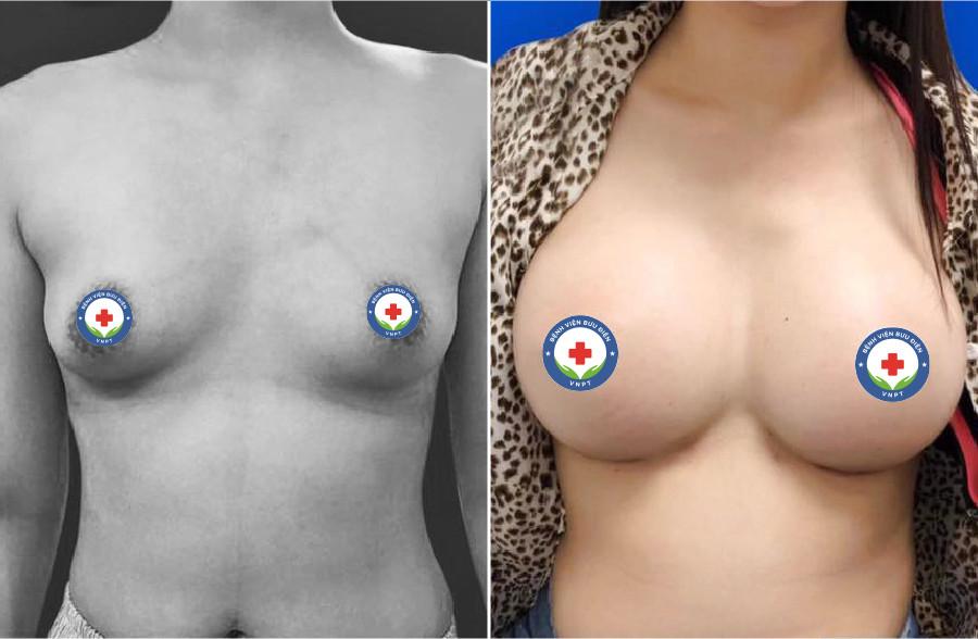 Hình ảnh trước và sau khi nâng ngực sử dụng túi Nano Chip của Motiva